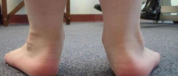 Плосковальгусные стопы - причины, степени и диагностика: лечение искривления и профилактика заболевания, польза ношения ортопедической обуви